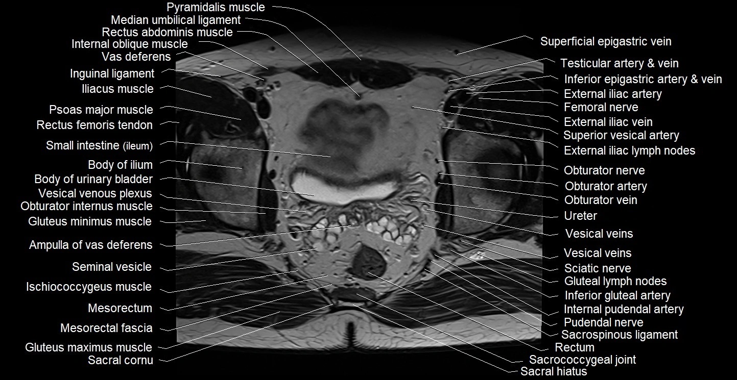 Male pelvis axial cross sectional anatomy image 23.webp